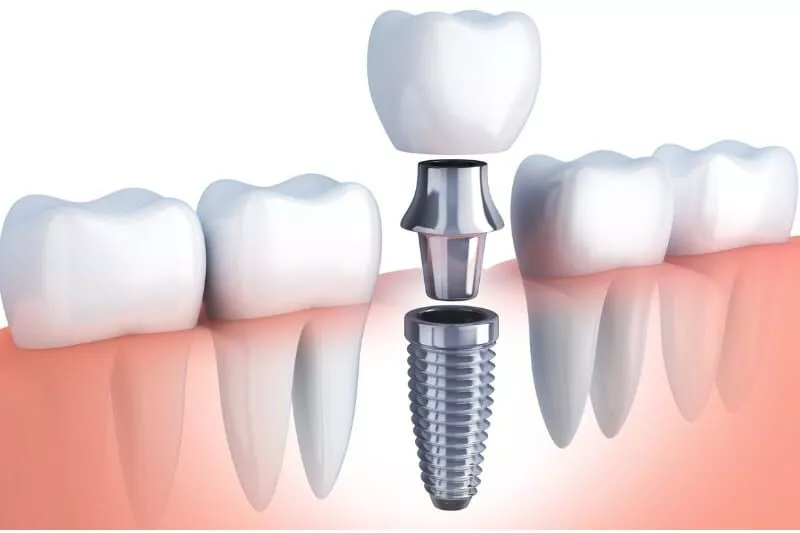 Dental Implant Healing Stages: What to Expect After Your Implant Surgery