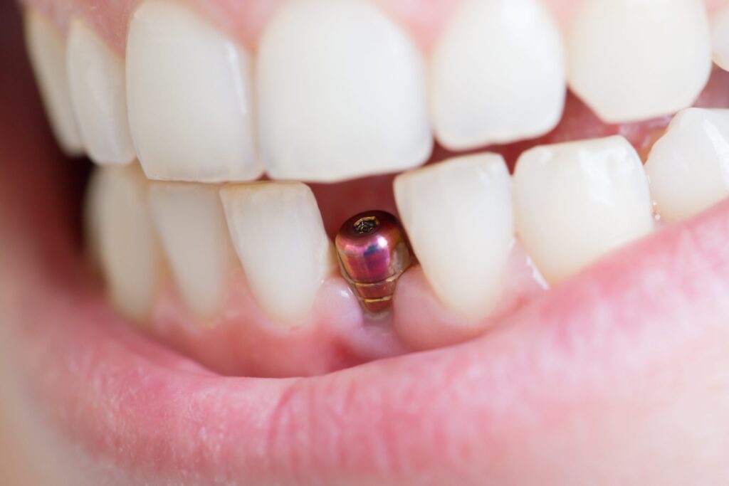 Dental Implant Healing Stages: What to Expect After Your Implant Surgery