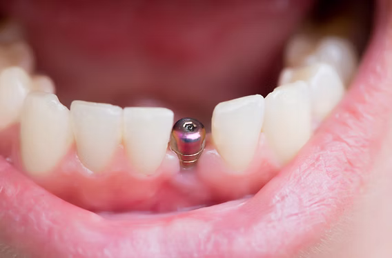 Dental Implant Healing Stages: What to Expect After Your Implant Surgery