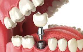 Dental Implant Healing Stages: What to Expect After Your Implant Surgery