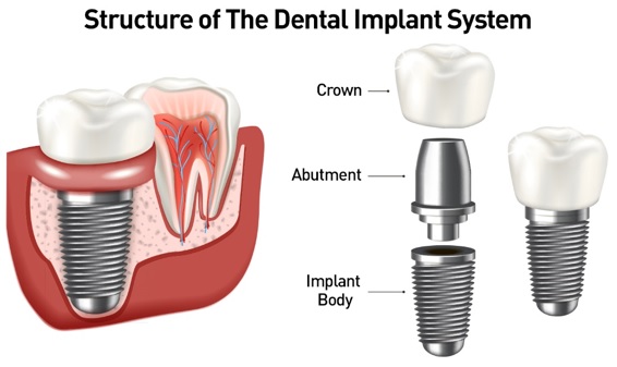 Dental Implant Healing Stages: What to Expect After Your Implant Surgery