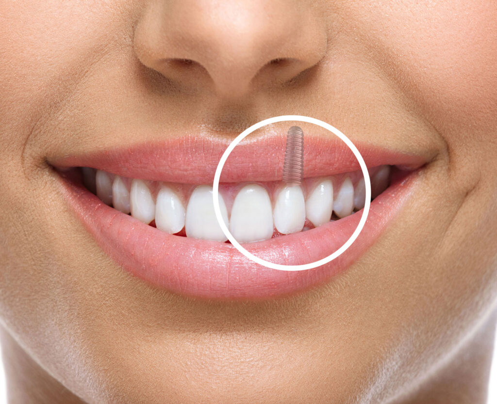 What is the Best Mouthwash to Use After Dental Implants?