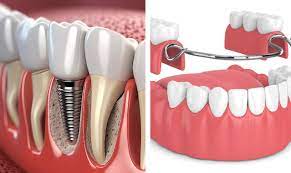 Same-Day Denture Repair Near Me