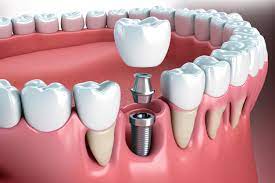 Top 12 Most Important Questions to Ask Before Getting a Full Mouth Reconstruction