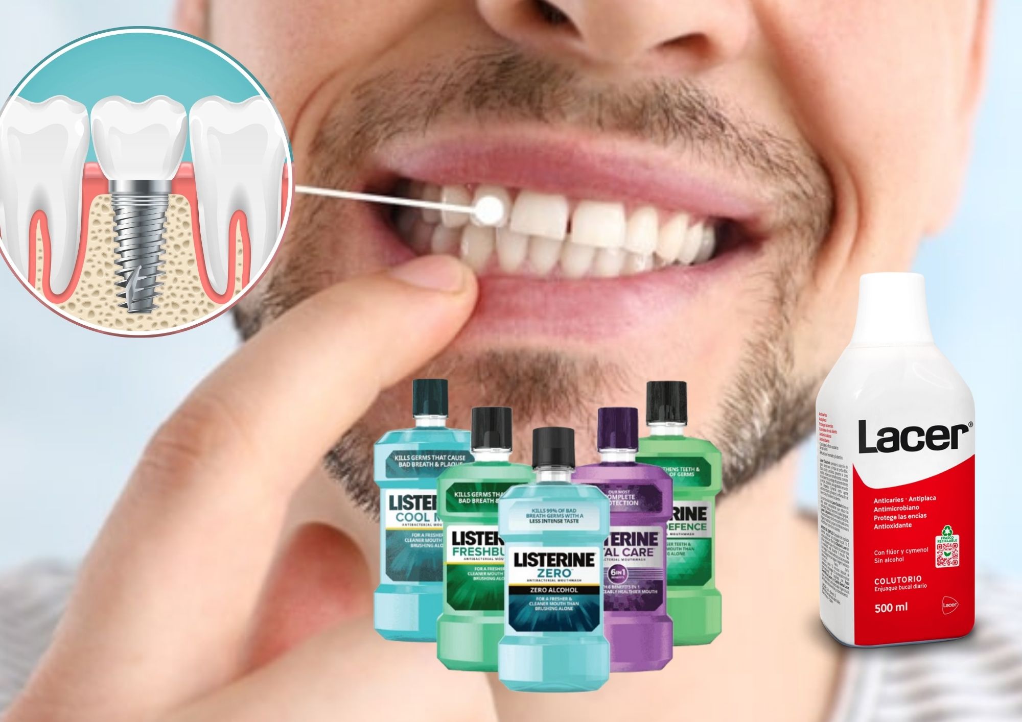 What is the Best Mouthwash to Use After Dental Implants?