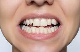Can you get veneers with crooked teeth?
