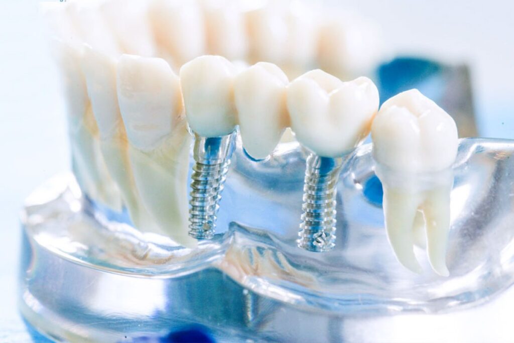 How Long Do Dental Implants Last? Lifespan & Maintenance Guide №1